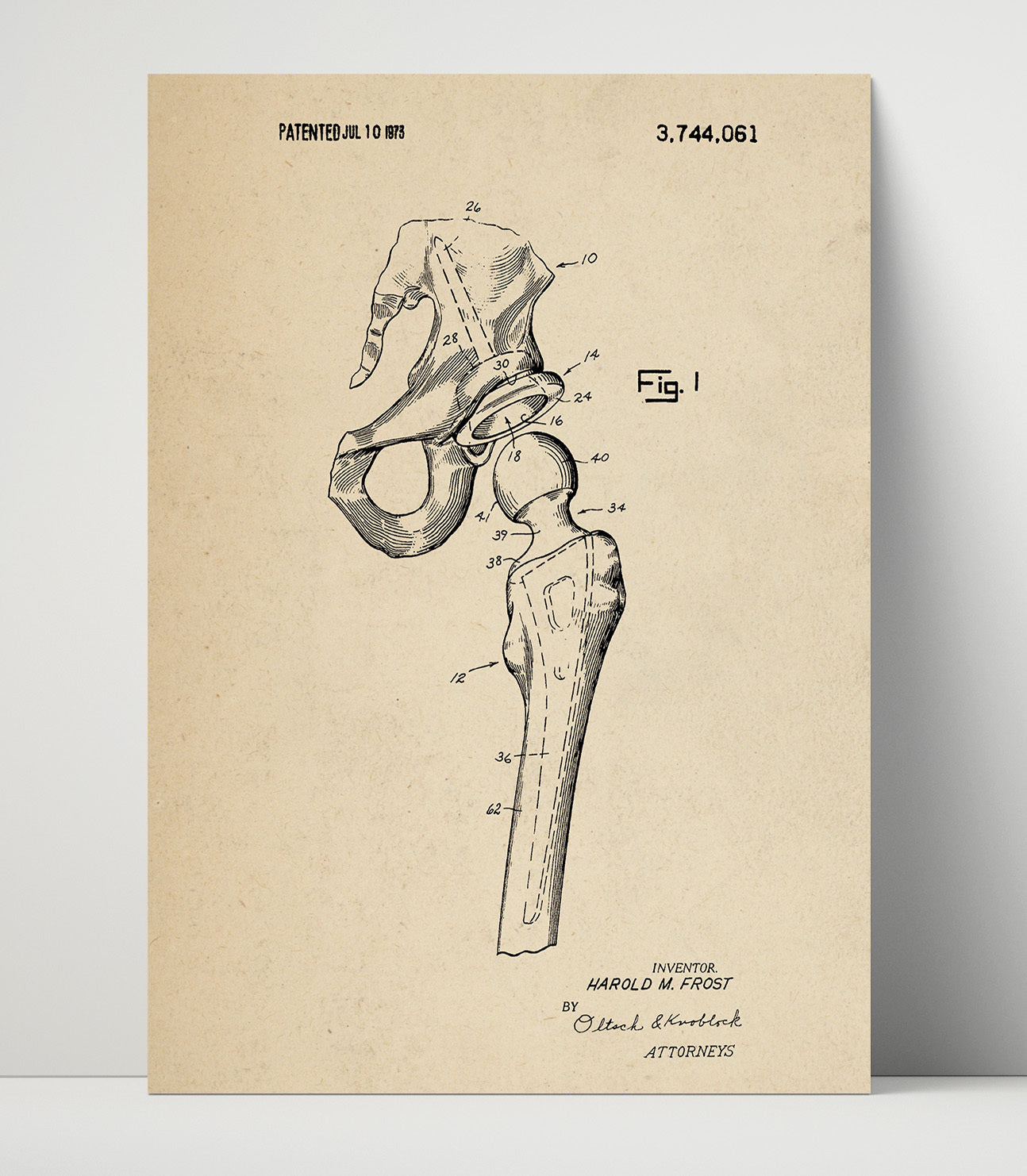 Patent Print - Artificial Hip Joint Prosthesis - Harold M. Frost - 1973 - Patent 3744061 Patent Wall Art