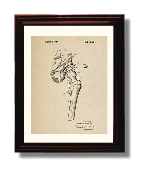 Patent Print - Artificial Hip Joint Prosthesis - Harold M. Frost - 1973 - Patent 3744061 Patent Wall Art