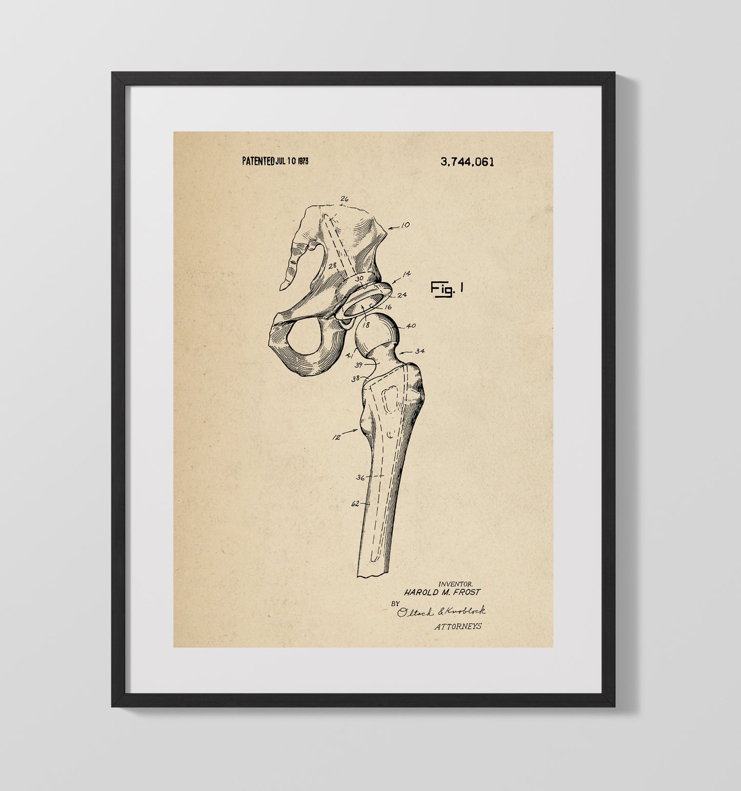 Patent Print - Artificial Hip Joint Prosthesis - Harold M. Frost - 1973 - Patent 3744061 Patent Wall Art