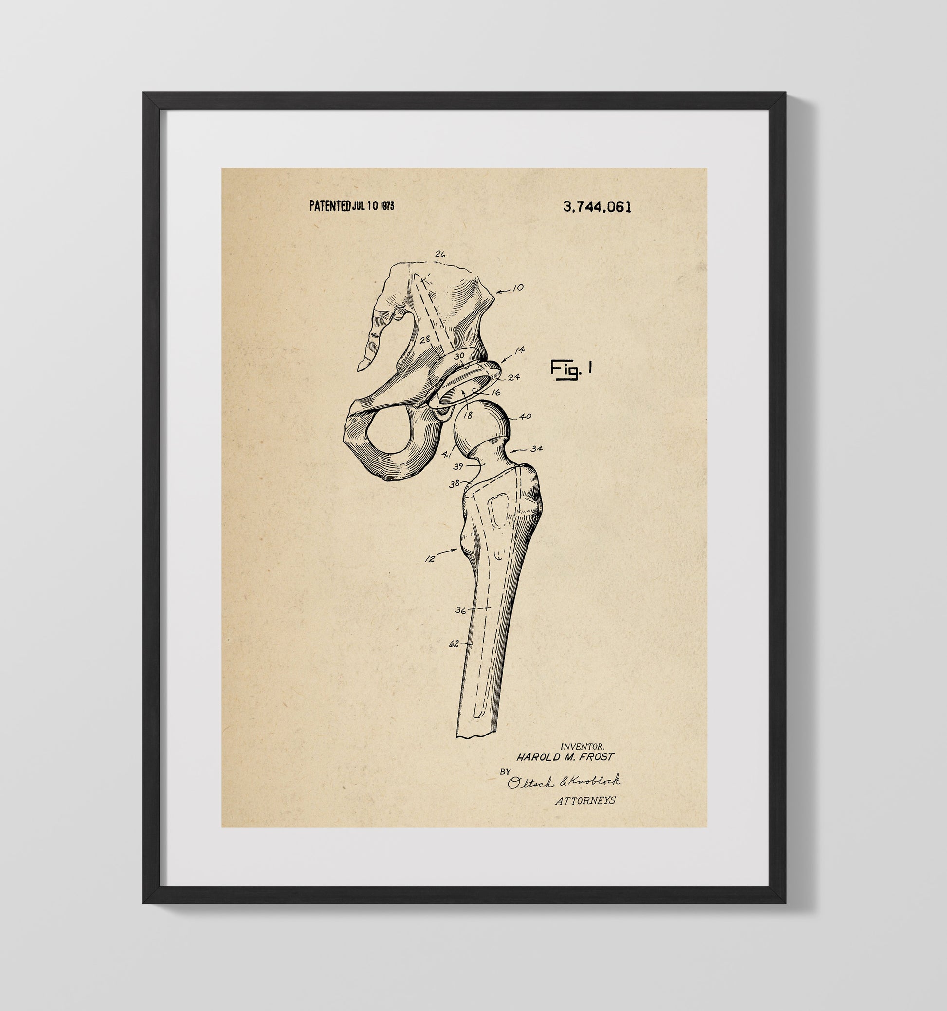 Patent Print - Artificial Hip Joint Prosthesis - Harold M. Frost - 1973 - Patent 3744061 Patent Wall Art