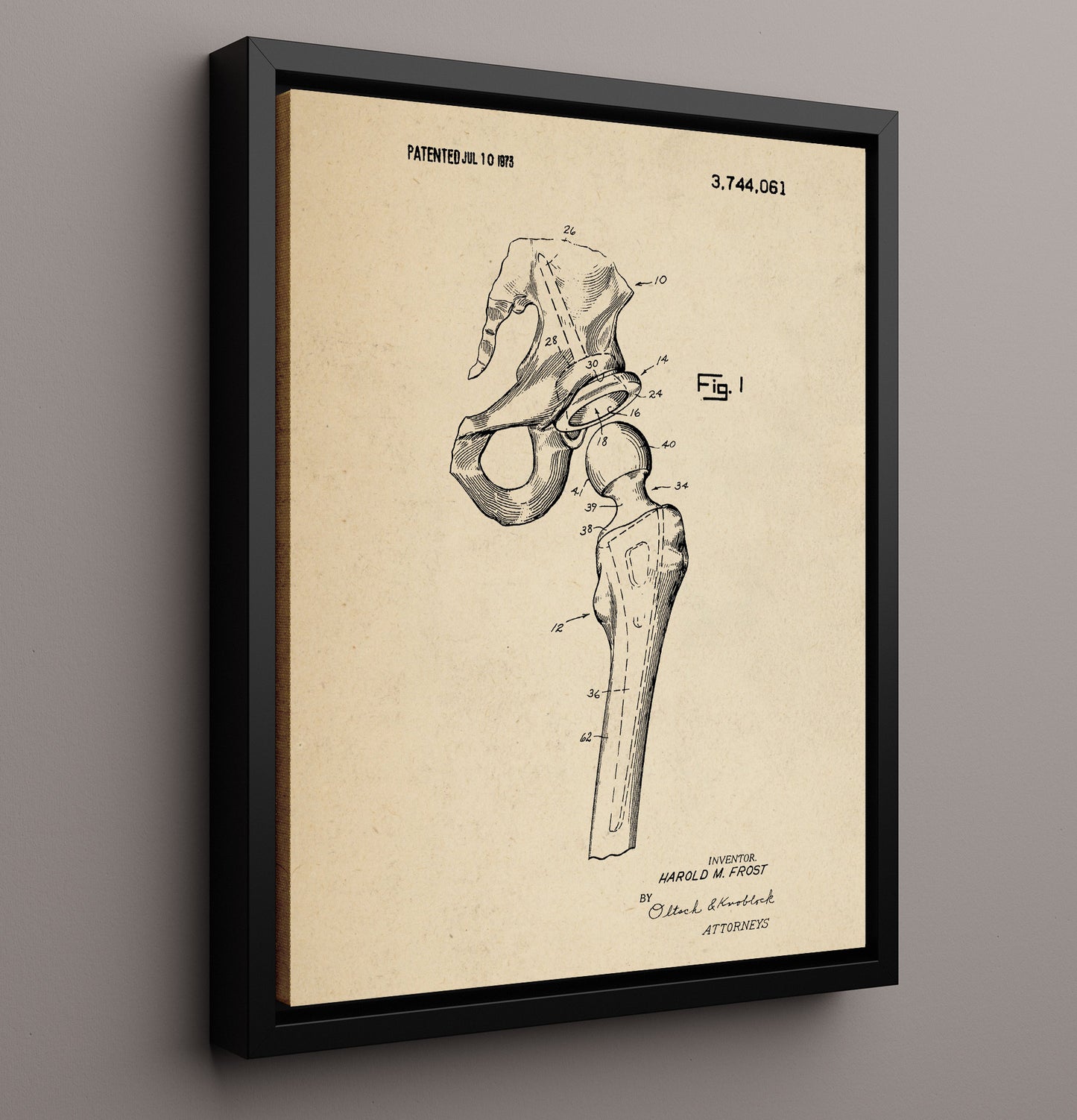 Patent Print - Artificial Hip Joint Prosthesis - Harold M. Frost - 1973 - Patent 3744061 Patent Wall Art
