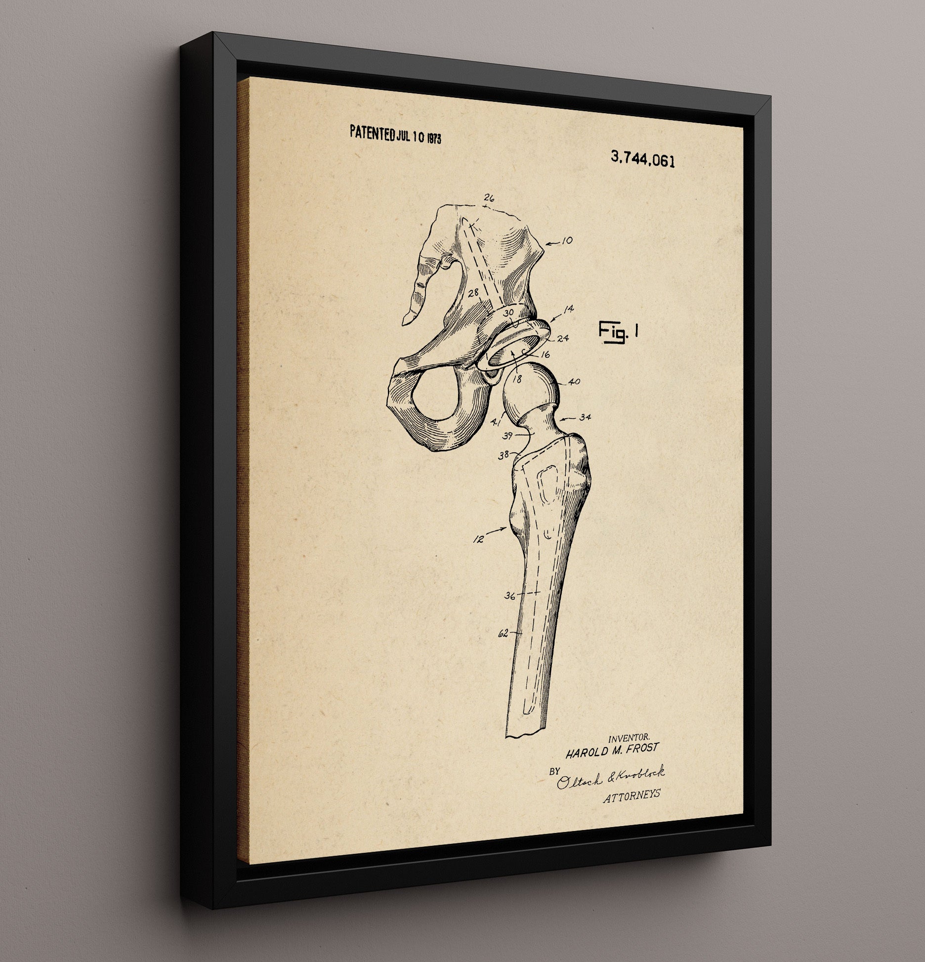 Patent Print - Artificial Hip Joint Prosthesis - Harold M. Frost - 1973 - Patent 3744061 Patent Wall Art