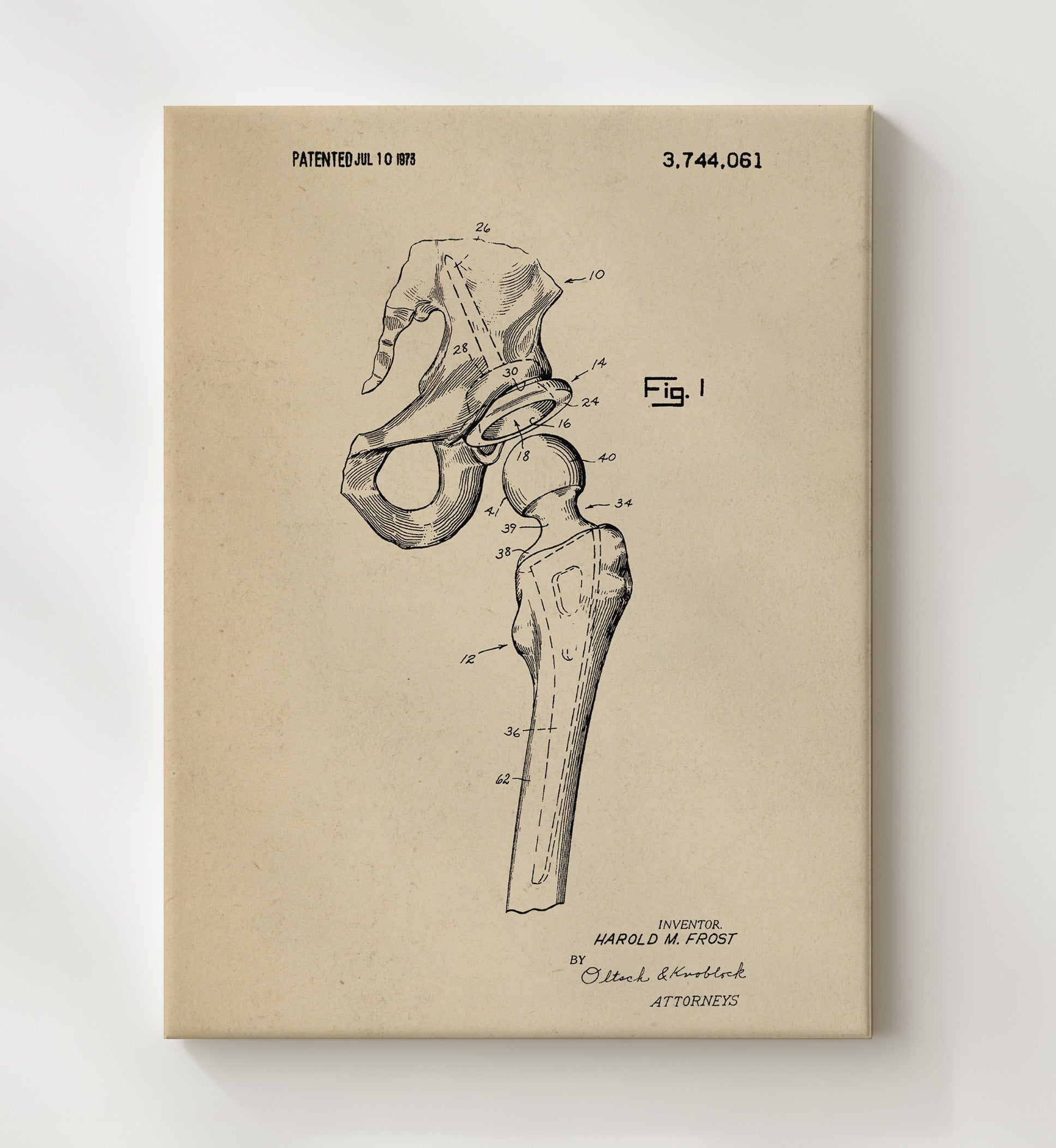 Patent Print - Artificial Hip Joint Prosthesis - Harold M. Frost - 1973 - Patent 3744061 Patent Wall Art