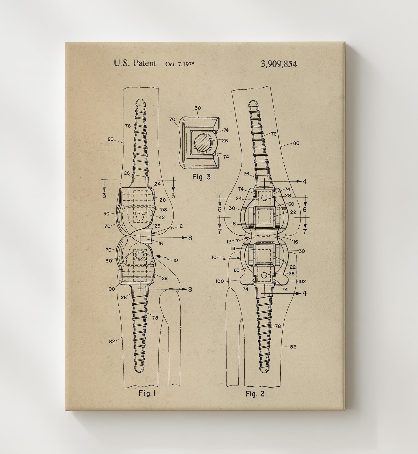Patent Print - Orthopedic Bone Fastener - Internal Fixation Device - 1975 - Patent 3909854 Patent Wall Art