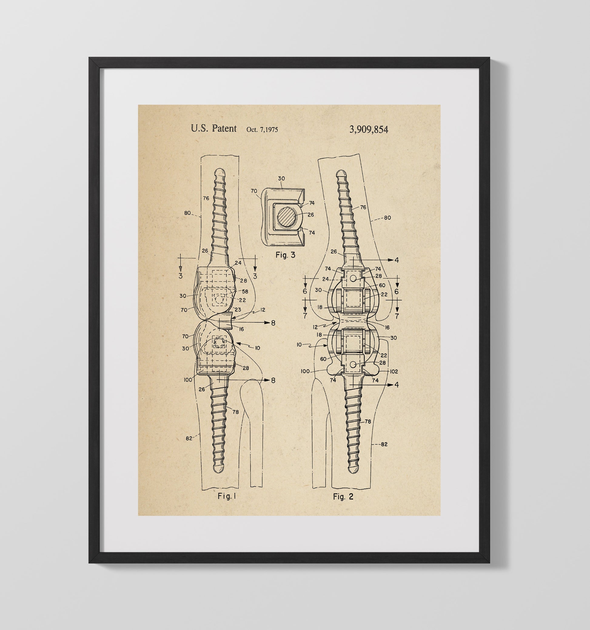 Patent Print - Orthopedic Bone Fastener - Internal Fixation Device - 1975 - Patent 3909854 Patent Wall Art