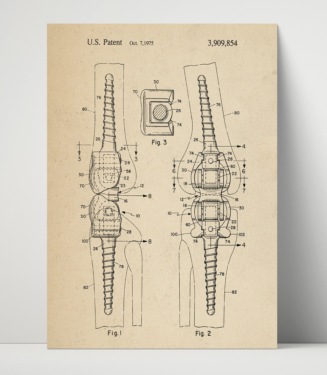 Patent Print - Orthopedic Bone Fastener - Internal Fixation Device - 1975 - Patent 3909854 Patent Wall Art